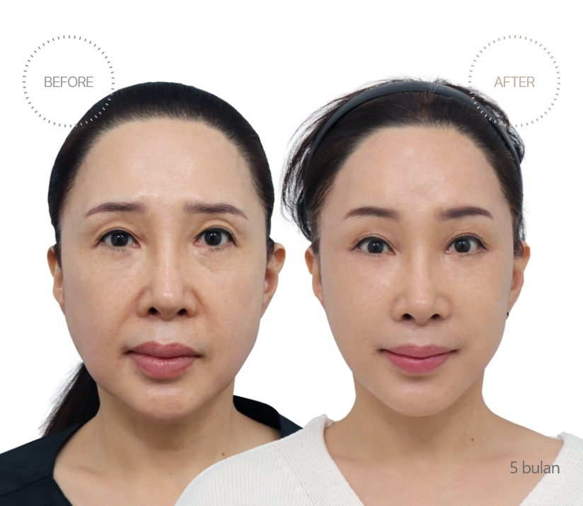 5bulan BEFORE - AFTER