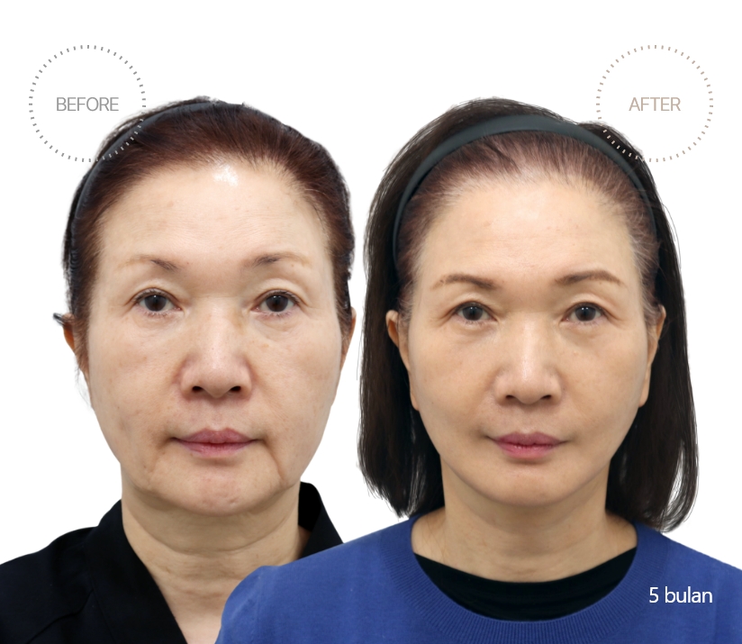 5bulan BEFORE - AFTER