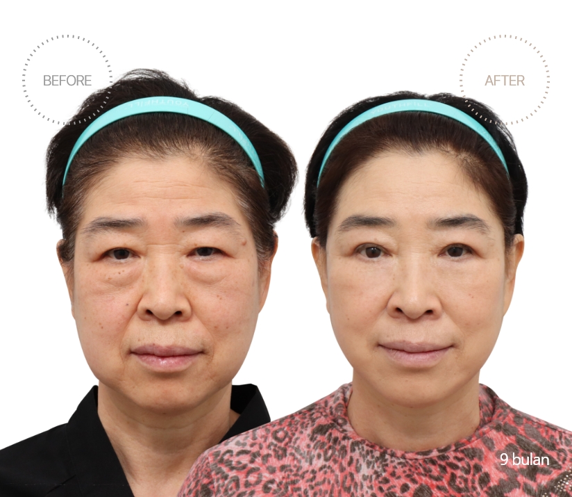 5bulan BEFORE - AFTER