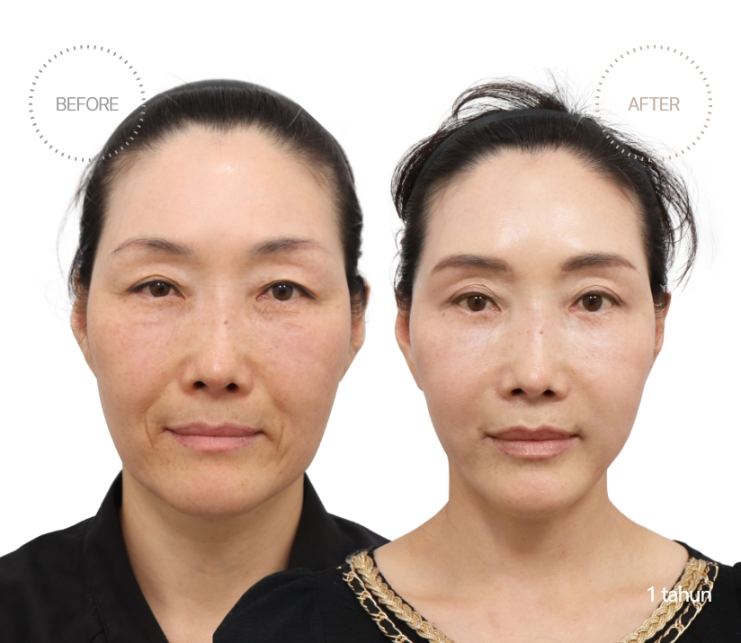 5bulan BEFORE - AFTER