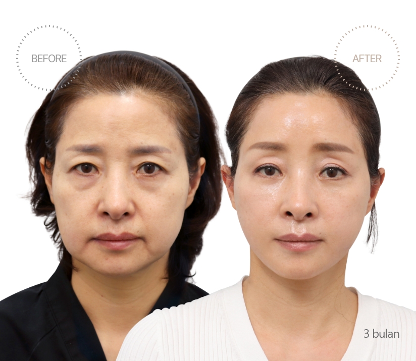 5bulan BEFORE - AFTER