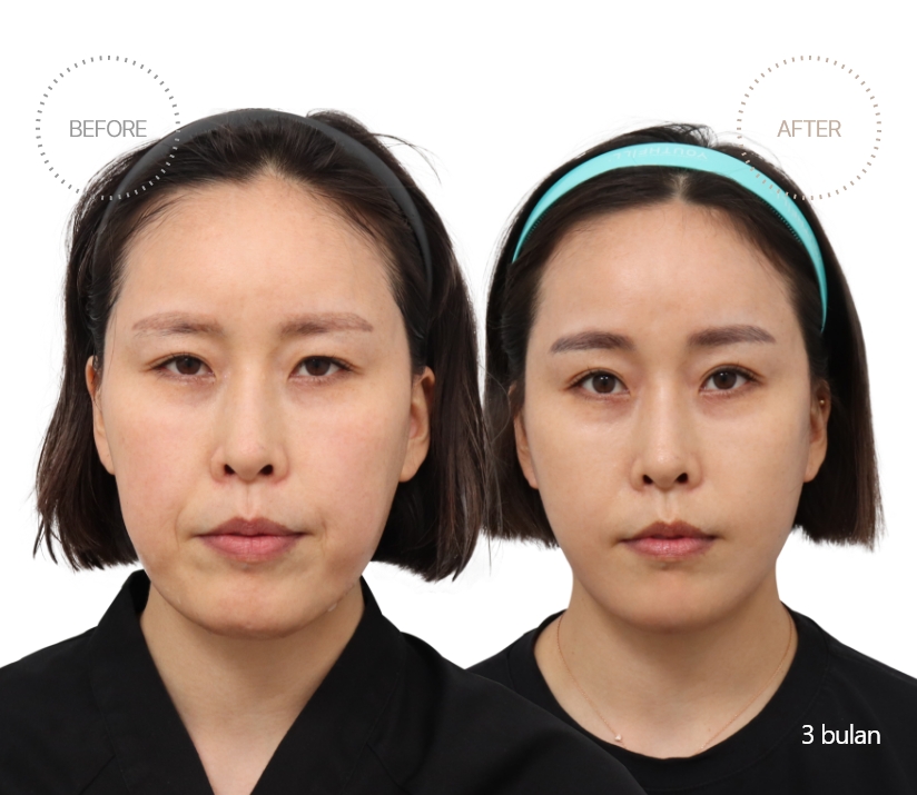 5bulan BEFORE - AFTER