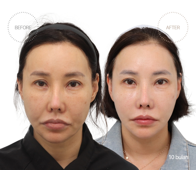 5bulan BEFORE - AFTER