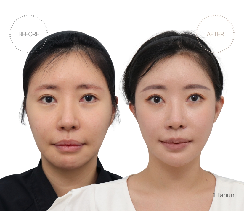 5bulan BEFORE - AFTER