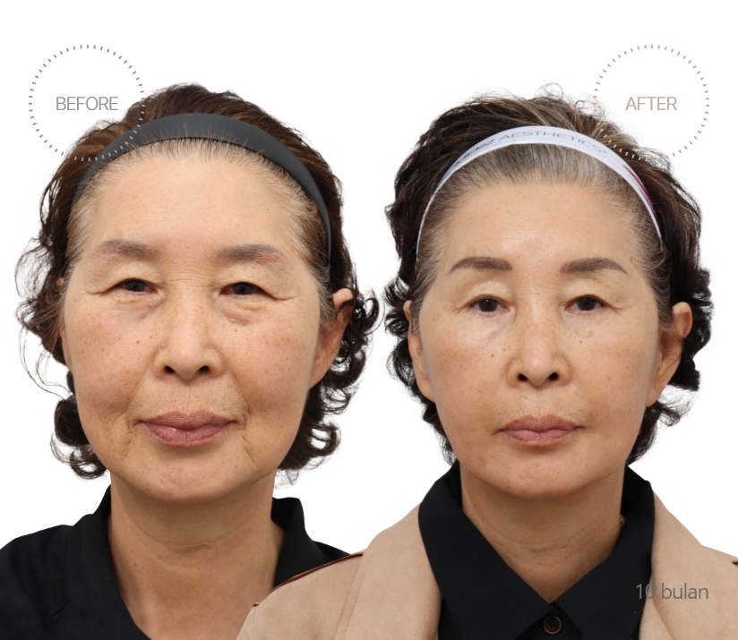 5bulan BEFORE - AFTER