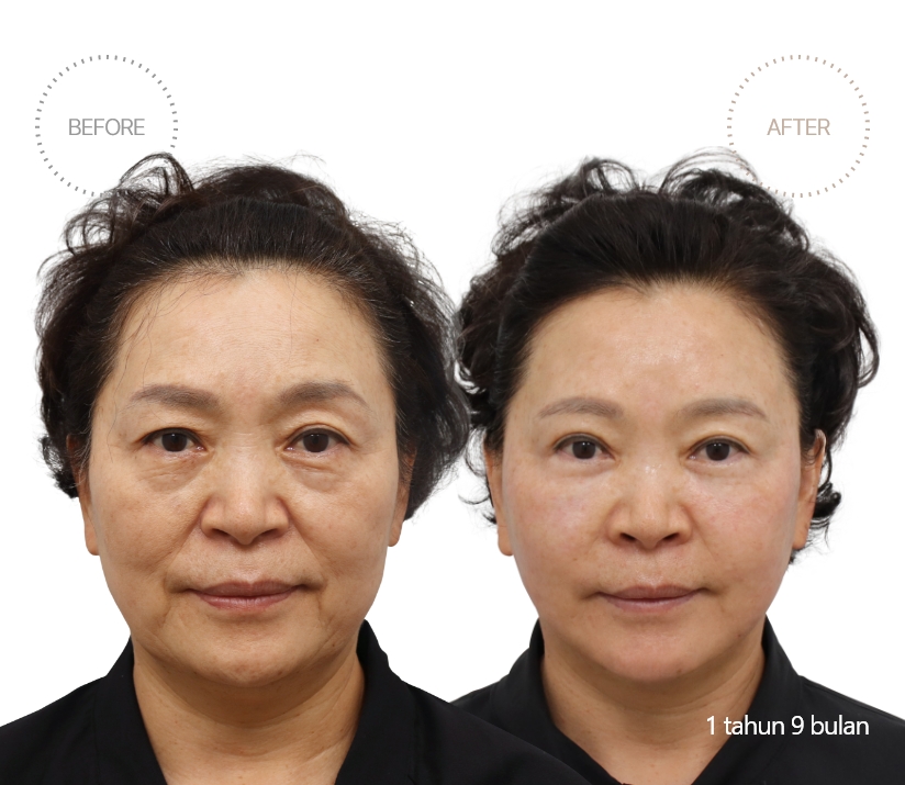 5bulan BEFORE - AFTER