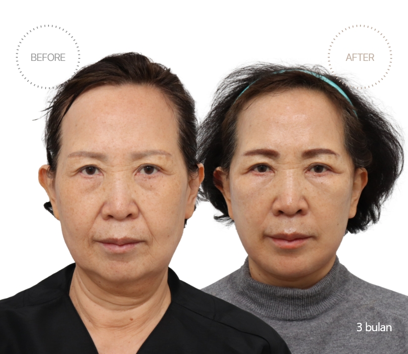 5bulan BEFORE - AFTER