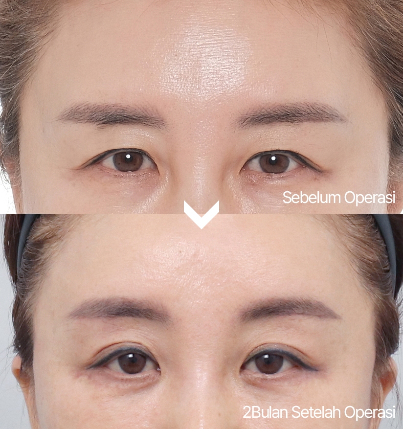 Sebelum Operasi 2Bulan Setelah Operasi