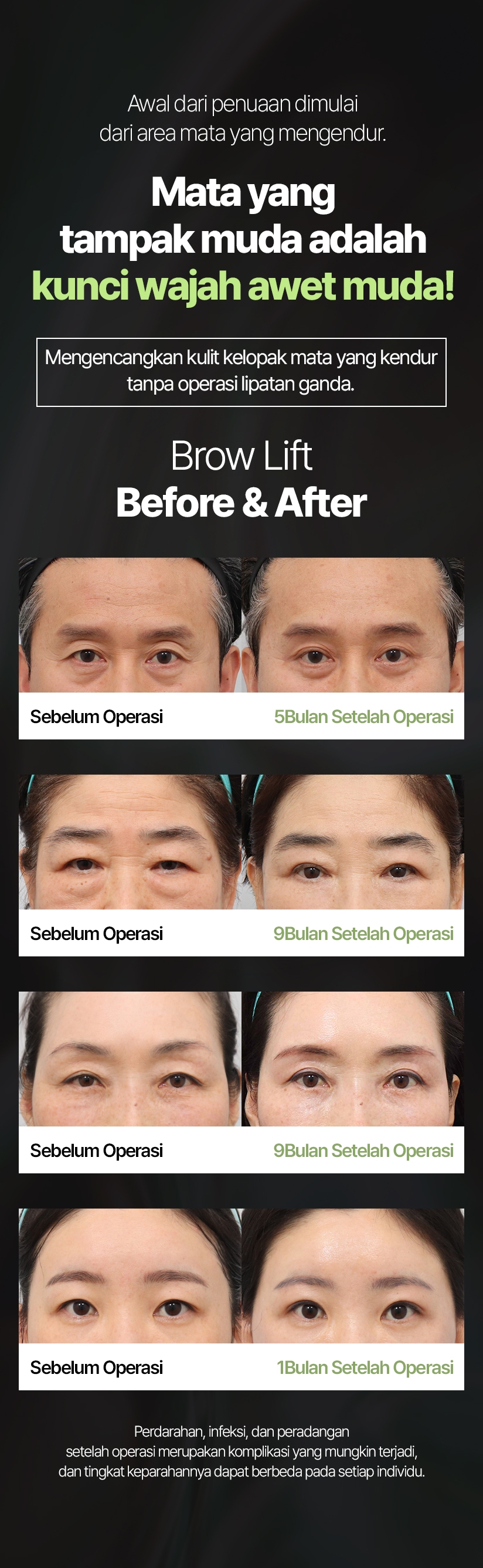 Awal dari penuaan dimulai dari area mata yang mengendur. Mata yang tampak muda adalah kunci wajah awet muda! Mengencangkan kulit kelopak mata yang kendur tanpa operasi lipatan ganda. Brow Lift Before & After Sebelum Operasi 5Bulan Setelah Operasi Perdarahan, infeksi, dan peradangan setelah operasi merupakan komplikasi yang mungkin terjadi, dan tingkat keparahannya dapat berbeda pada setiap individu.