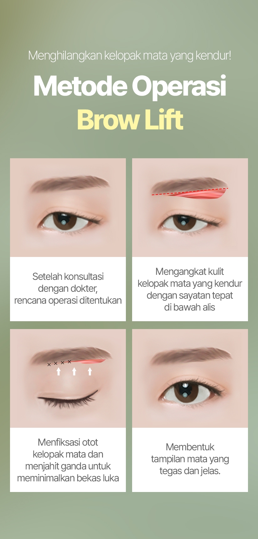 Menghilangkan kelopak mata yang kendur! Metode Operasi Brow Lift Setelah konsultasi dengan dokter, rencana operasi ditentukan Mengangkat kulit kelopak mata yang kendur dengan sayatan tepat di bawah alis Menfiksasi otot kelopak mata dan menjahit ganda untuk meminimalkan bekas luka Membentuk tampilan mata yang tegas dan jelas.