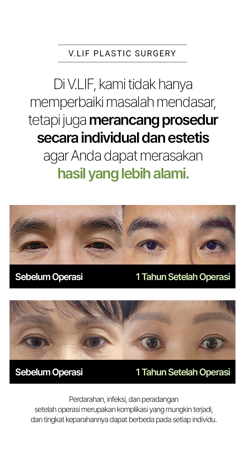 V.LIF PLASTIC SURGERY Di V.LIF, kami tidak hanya memperbaiki masalah mendasar, tetapi juga merancang prosedur secara individual dan estetis agar Anda dapat merasakan hasil yang lebih alami. Sebelum Operasi 1 Tahun Setelah Operasi Perdarahan, infeksi, dan peradangan setelah operasi merupakan komplikasi yang mungkin terjadi, dan tingkat keparahannya dapat berbeda pada setiap individu.
