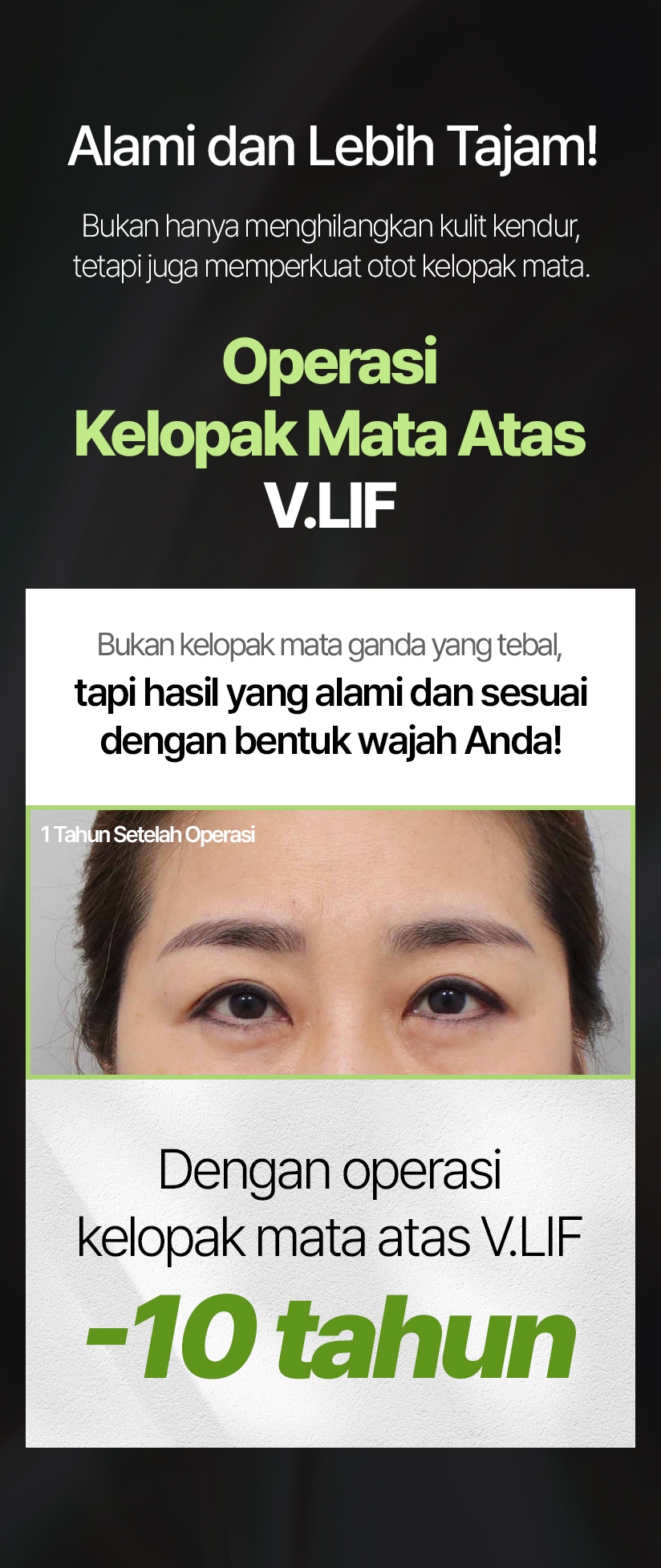 Alami dan Lebih Tajam! Bukan hanya menghilangkan kulit kendur, tetapi juga memperkuat otot kelopak mata. Operasi Kelopak Mata Atas V.LIF Bukan kelopak mata ganda yang tebal, tapi hasil yang alami dan sesuai dengan bentuk wajah Anda! 1 Tahun Setelah Operasi Dengan operasi kelopak mata atas V.LIF -10 tahun