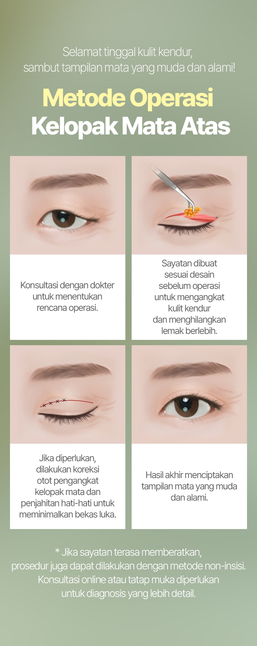 Selamat tinggal kulit kendur, sambut tampilan mata yang muda dan alami! Metode Operasi Kelopak Mata Atas Konsultasi dengan dokter untuk menentukan rencana operasi. Sayatan dibuat sesuai desain sebelum operasi untuk mengangkat kulit kendur dan menghilangkan lemak berlebih. Jika diperlukan, dilakukan koreksi otot pengangkat kelopak mata dan penjahitan hati-hati untuk meminimalkan bekas luka. Hasil akhir menciptakan tampilan mata yang muda dan alami. * Jika sayatan terasa memberatkan, prosedur juga dapat dilakukan dengan metode non-insisi. Konsultasi online atau tatap muka diperlukan untuk diagnosis yang lebih detail.