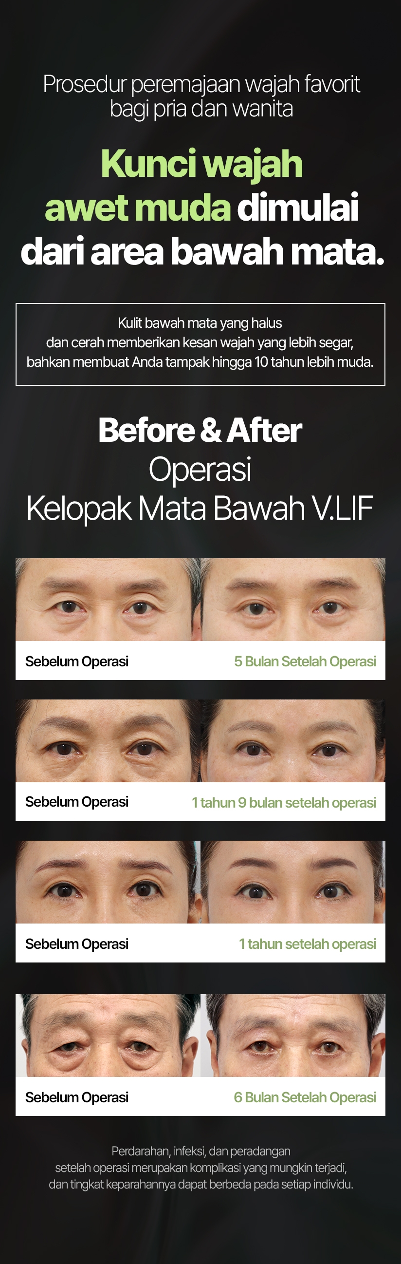 Prosedur peremajaan wajah favorit bagi pria dan wanita Kunci wajah awet muda dimulai dari area bawah mata. Kulit bawah mata yang halus dan cerah memberikan kesan wajah yang lebih segar, bahkan membuat Anda tampak hingga 10 tahun lebih muda. Before & After Operasi Kelopak Mata Bawah V.LIF Sebelum Operasi 5 Bulan Setelah Operasi 1 tahun 9 bulan setelah operasi 1 Tahun Setelah Operasi 6 Bulan Setelah Operasi Perdarahan, infeksi, dan peradangan setelah operasi merupakan komplikasi yang mungkin terjadi, dan tingkat keparahannya dapat berbeda pada setiap individu.