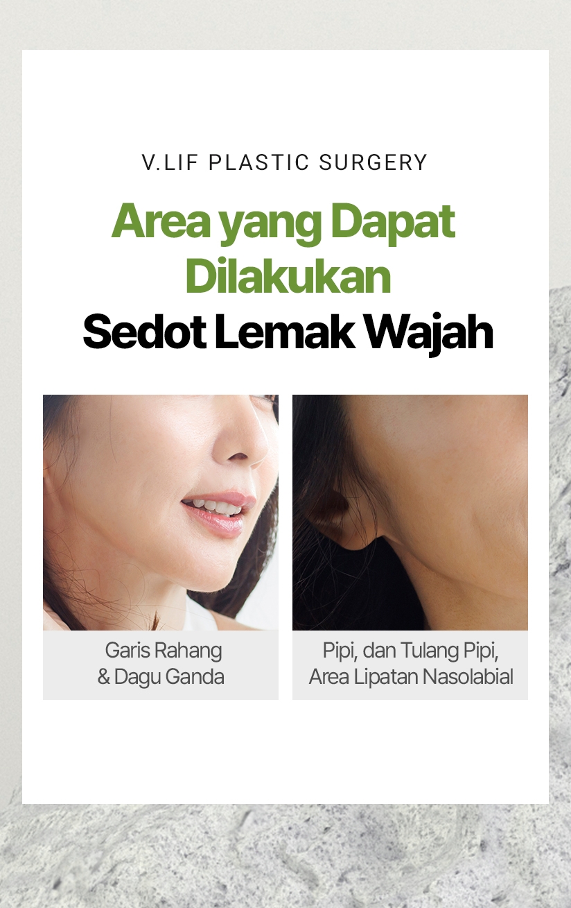 V.LIF PLASTIC SURGERY Area yang Dapat Dilakukan Sedot Lemak Wajah Garis Rahang & Dagu Ganda Pipi, Area Lipatan Nasolabial, dan Tulang Pipi