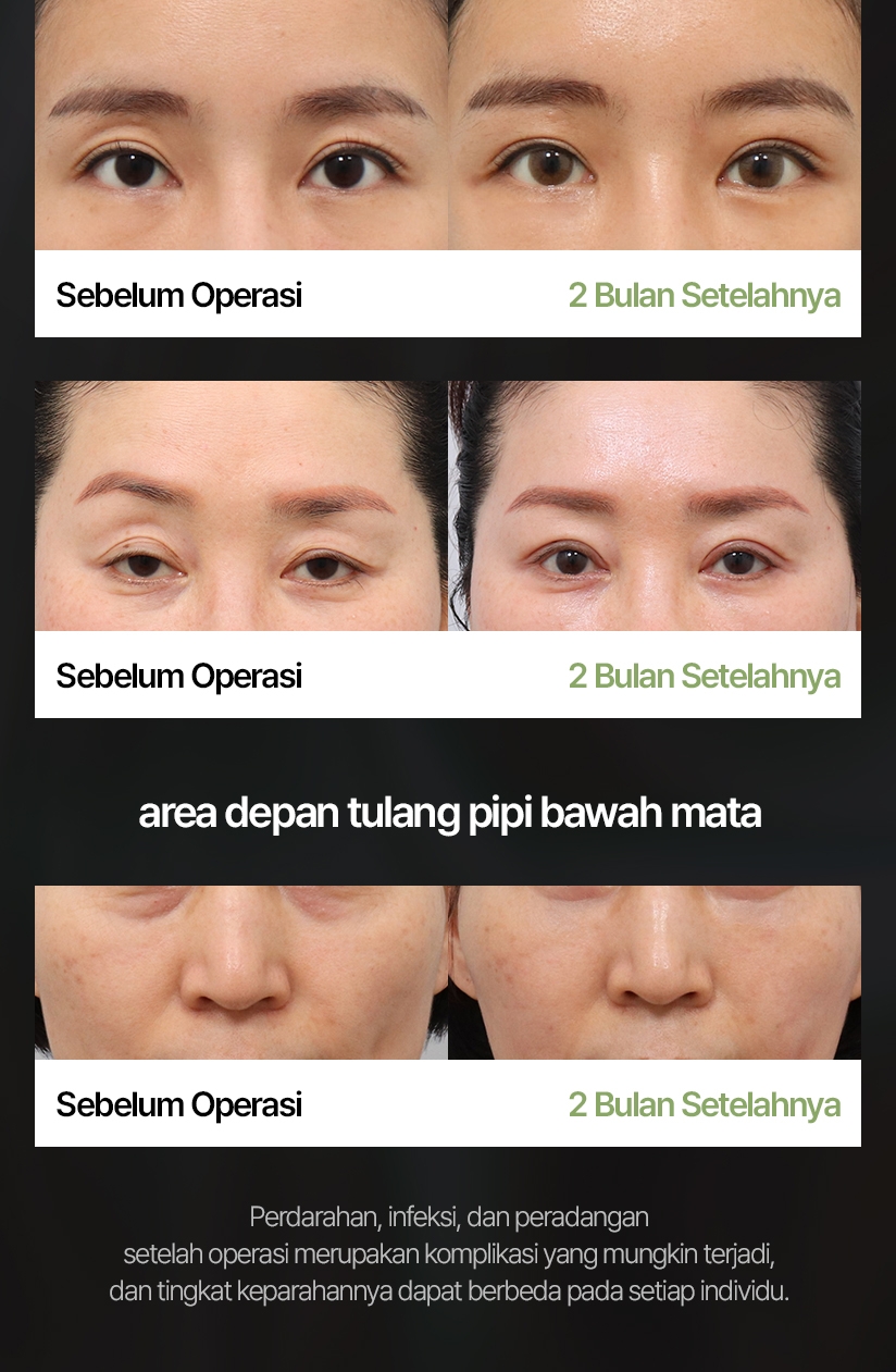 Fat Grafting Before & After Perbaikan pada area kelopak mata atas yang tampak cekung Sebelum Operasi 2 Bulan Setelahnya area depan tulang pipi bawah mata Perdarahan, infeksi, dan peradangan setelah operasi merupakan komplikasi yang mungkin terjadi, dan tingkat keparahannya dapat berbeda pada setiap individu.