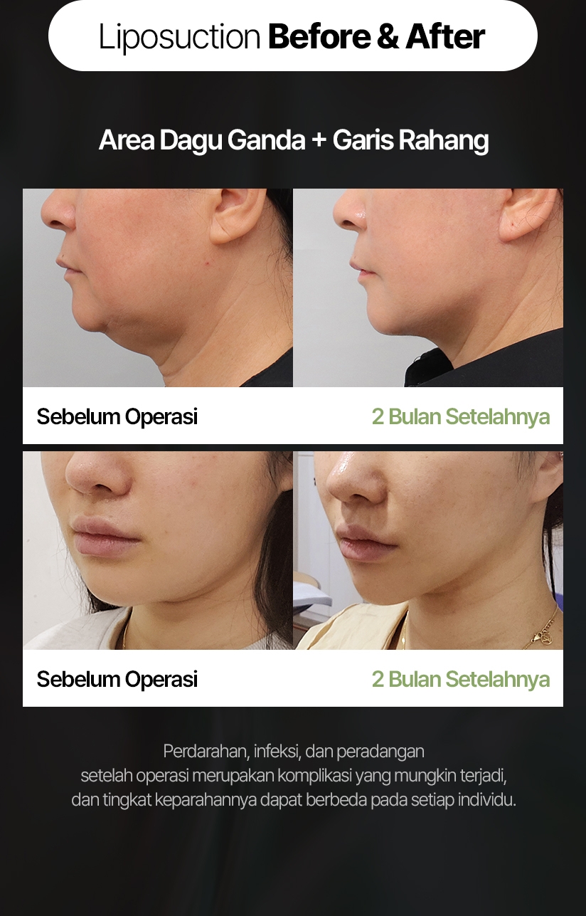 Sebelum Operasi 2 Bulan Setelahnya Perdarahan, infeksi, dan peradangan setelah operasi merupakan komplikasi yang mungkin terjadi, dan tingkat keparahannya dapat berbeda pada setiap individu.