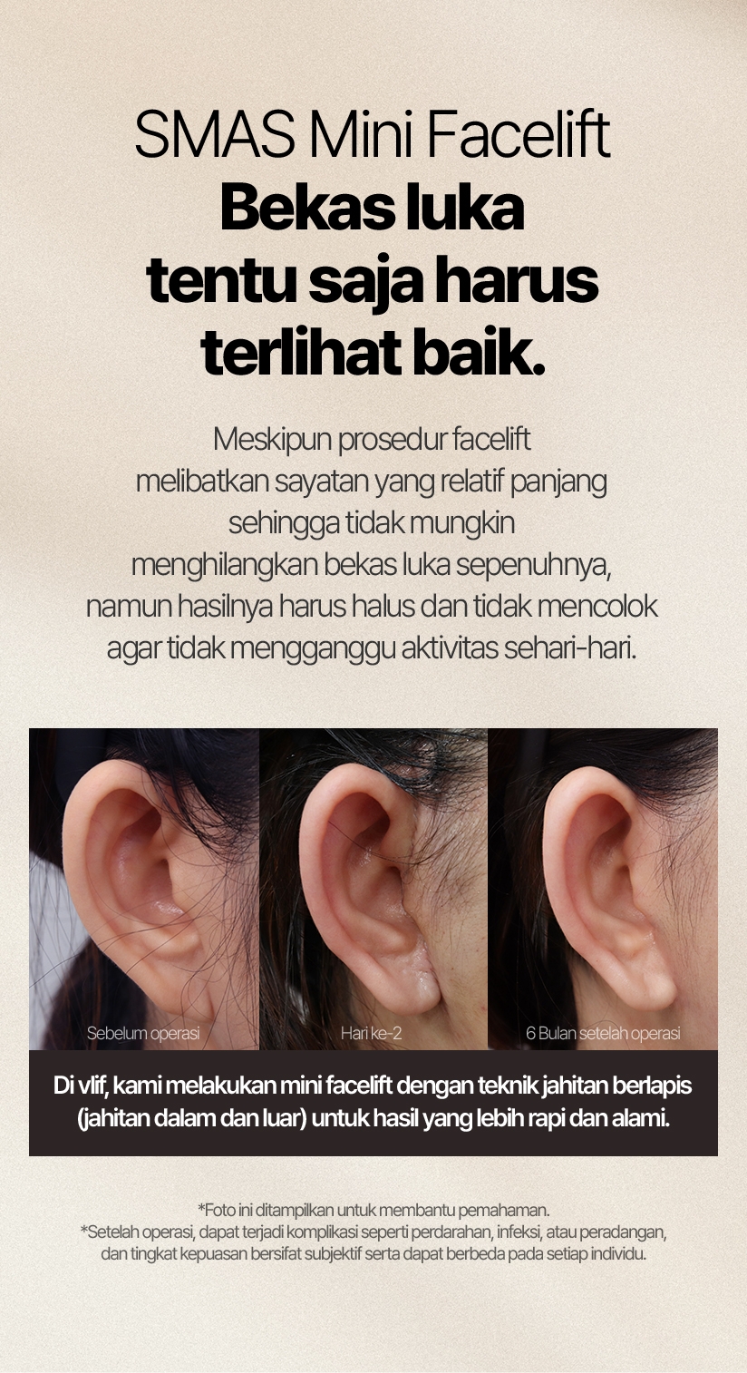 SMAS Mini Facelift Bekas luka tentu saja harus terlihat baik. Meskipun prosedur facelift melibatkan sayatan yang relatif panjang sehingga tidak mungkin menghilangkan bekas luka sepenuhnya, namun hasilnya harus halus dan tidak mencolok agar tidak mengganggu aktivitas sehari-hari. Di vlif, kami melakukan mini facelift dengan teknik jahitan berlapis (jahitan dalam dan luar) untuk hasil yang lebih rapi dan alami.