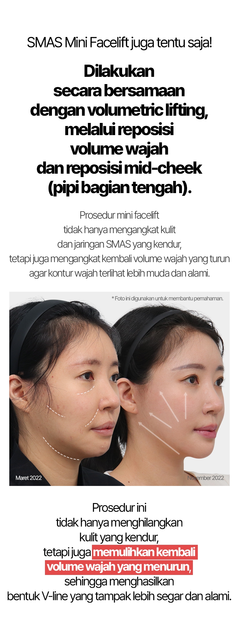 SMAS Mini Facelift juga tentu saja! Dilakukan secara bersamaan dengan volumetric lifting, melalui reposisi volume wajah dan reposisi mid-cheek (pipi bagian tengah). Prosedur mini facelift tidak hanya mengangkat kulit dan jaringan SMAS yang kendur, tetapi juga mengangkat kembali volume wajah yang turun agar kontur wajah terlihat lebih muda dan alami. Maret 2022 / November 2022 Prosedur ini tidak hanya menghilangkan kulit yang kendur, tetapi juga memulihkan kembali volume wajah yang menurun, sehingga menghasilkan bentuk V-line yang tampak lebih segar dan alami.