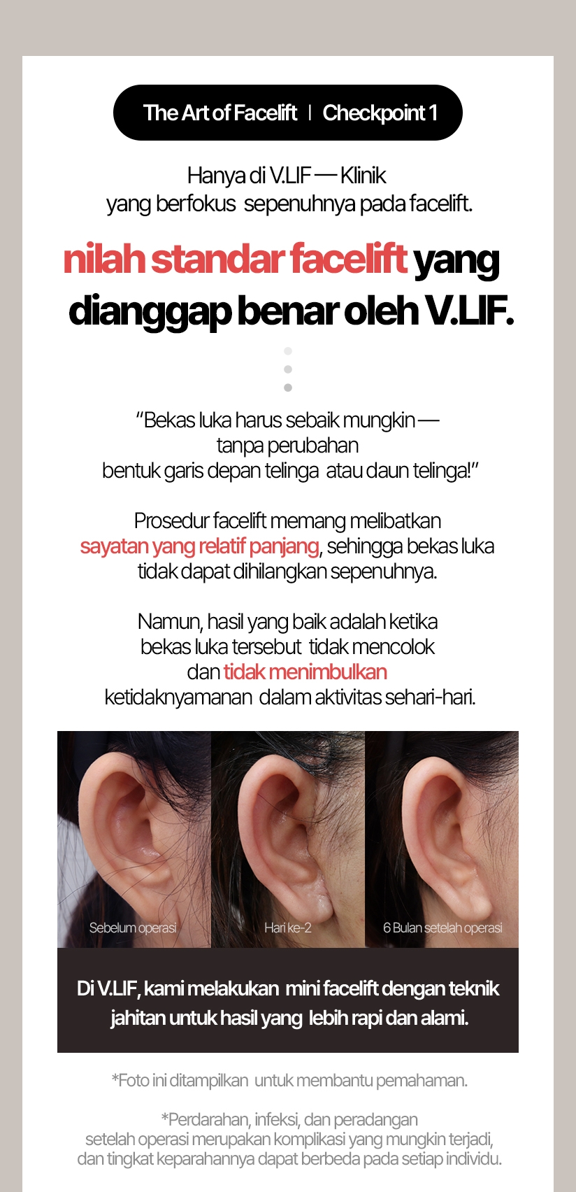 The Art of Facelift / Checkpoint 1 Hanya di VLIF — Klinik yang berfokus sepenuhnya pada facelift. nilah standar facelift yang  dianggap benar oleh VLIF. “Bekas luka harus sebaik mungkin — tanpa perubahan bentuk garis depan telinga atau daun telinga!” Prosedur facelift memang melibatkan sayatan yang relatif panjang, sehingga bekas luka tidak dapat dihilangkan sepenuhnya. Namun, hasil yang baik adalah ketika bekas luka tersebut tidak mencolok dan tidak menimbulkan ketidaknyamanan dalam aktivitas sehari-hari. Sebelum operasi / Hari ke-2 / 6 Bulan setelah operasi Di vlif, kami melakukan mini facelift dengan teknik jahitan untuk hasil yang lebih rapi dan alami. Foto ini ditampilkan untuk membantu pemahaman. Setelah operasi, dapat terjadi komplikasi seperti perdarahan, infeksi, atau peradangan, dan tingkat kepuasan pasien dapat berbeda pada setiap individu