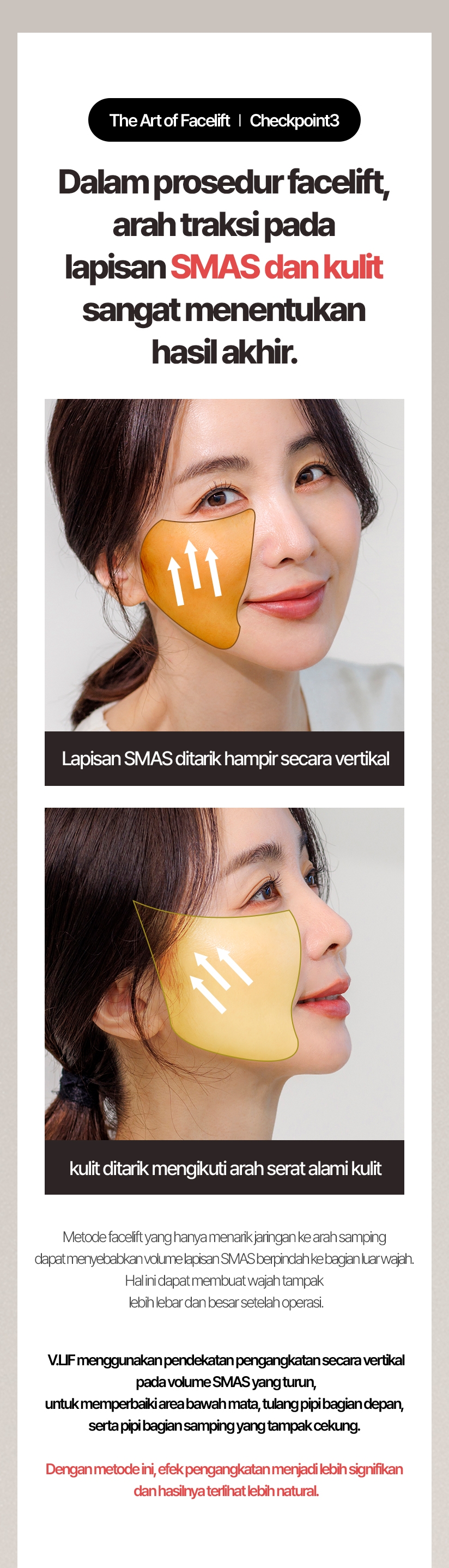 The Art of Facelift / Checkpoint 3 Dalam prosedur facelift, arah traksi pada lapisan SMAS dan kulit sangat menentukan hasil akhir. Lalu, ke arah mana penarikan tersebut sebaiknya dilakukan agar memberikan hasil yang optimal? Lapisan SMAS ditarik hampir secara vertikal kulit ditarik mengikuti arah serat alami kulit Metode facelift yang hanya menarik jaringan ke arah samping dapat menyebabkan volume lapisan SMAS berpindah ke bagian luar wajah. Hal ini dapat membuat wajah tampak lebih lebar dan besar setelah operasi. V.LIF menggunakan pendekatan pengangkatan secara vertikal pada volume SMAS yang turun, untuk memperbaiki area bawah mata, tulang pipi bagian depan, serta pipi bagian samping yang tampak cekung. Dengan metode ini, efek pengangkatan menjadi lebih signifikan dan hasilnya terlihat lebih natural.