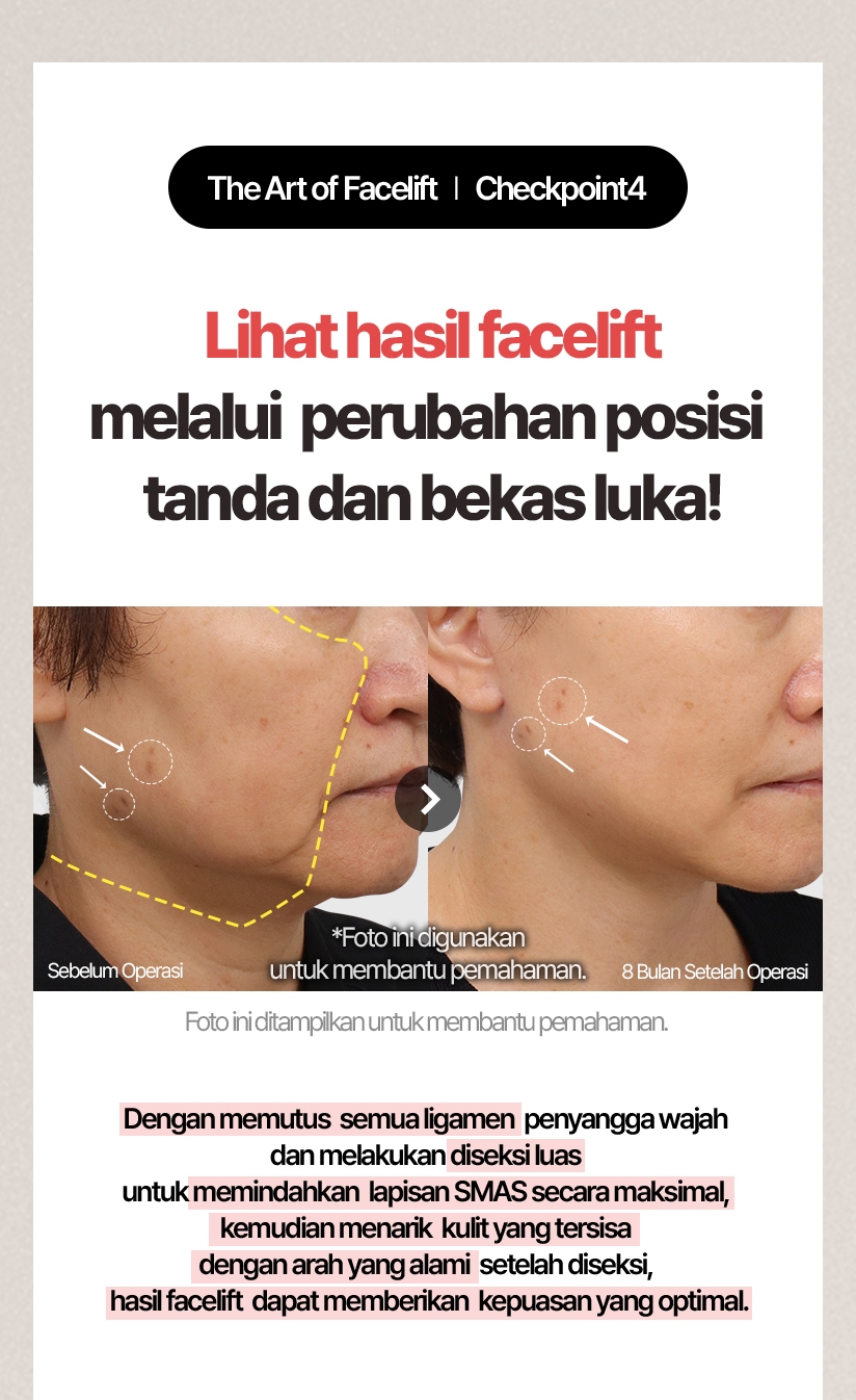 The Art of Facelift / Checkpoint 4 Lihat hasil facelift melalui perubahan posisi tanda dan bekas luka! Sebelum Operasi / 8 Bulan Setelah Operasi * Foto ini digunakan untuk membantu pemahaman. Foto ini ditampilkan untuk membantu pemahaman. Setelah operasi, dapat terjadi komplikasi seperti perdarahan, infeksi, atau peradangan, dan tingkat kepuasan pasien dapat berbeda pada setiap individu Dengan memutus semua ligamen penyangga wajah dan melakukan diseksi luas untuk memindahkan lapisan SMAS secara maksimal, kemudian menarik kulit  yang tersisa dengan arah yang alami setelah diseksi, hasil facelift dapat memberikan kepuasan yang optimal.
