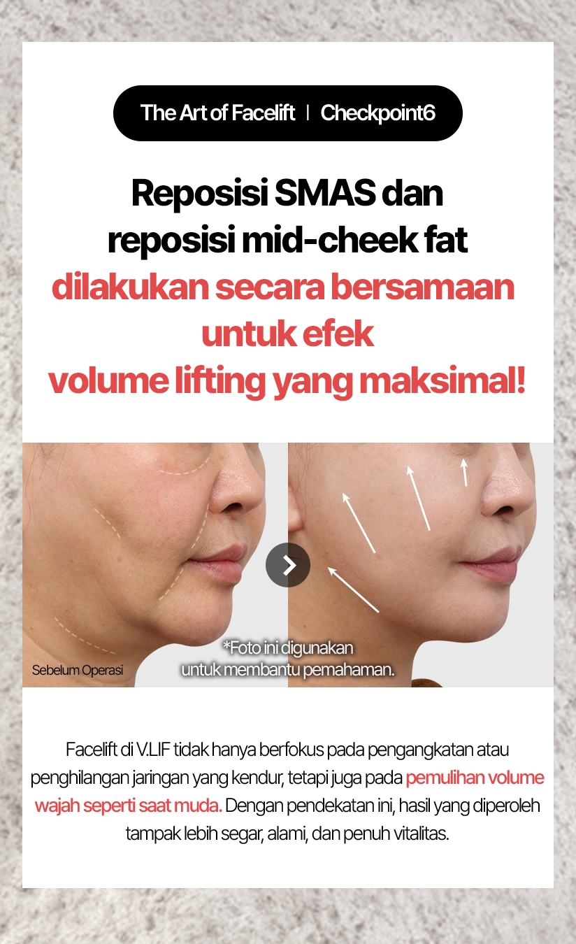 The Art of Facelift / Checkpoint 6 Reposisi SMAS dan reposisi mid-cheek fat dilakukan secara bersamaan untuk efek volume lifting yang maksimal! Sebelum Operasi / 9 Bulan Setelah Operasi Facelift di V.LIF tidak hanya berfokus pada pengangkatan atau penghilangan jaringan yang kendur, tetapi juga pada pemulihan volume wajah seperti saat muda. Dengan pendekatan ini, hasil yang diperoleh tampak lebih segar, alami, dan penuh vitalitas.