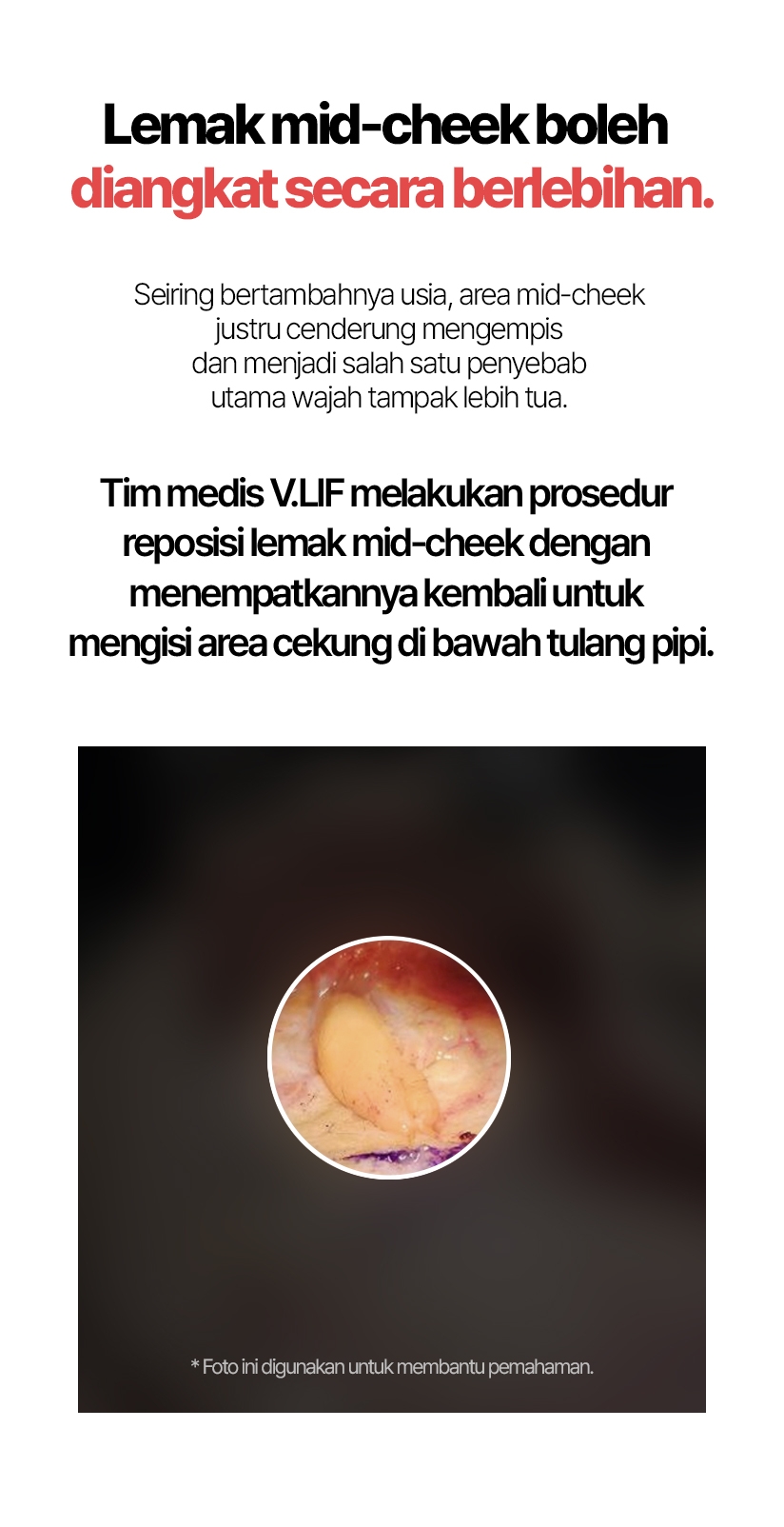 Lemak mid-cheek boleh diangkat secara berlebihan. Seiring bertambahnya usia, area mid-cheek justru cenderung mengempis dan menjadi salah satu penyebab utama wajah tampak lebih tua. Tim medis V.LIF melakukan prosedur reposisi lemak mid-cheek dengan menempatkannya kembali untuk mengisi area cekung di bawah tulang pipi.