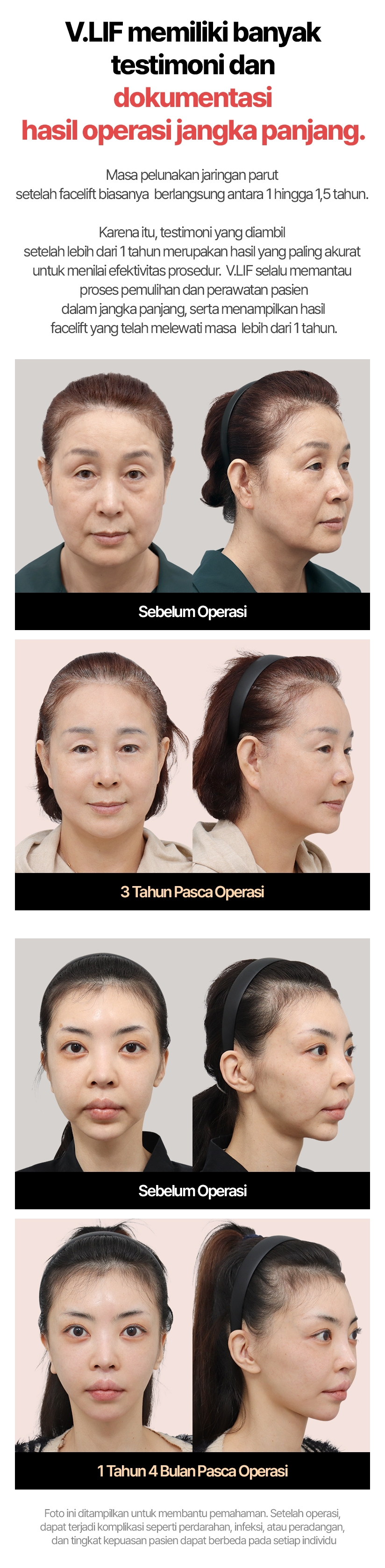 Facelift V.LIF Dibuktikan oleh Waktu. Kepuasan Tinggi, Hasil yang Tahan Lama Fakta, bukan sekadar rumor — hasil facelift V.LIF memang terbukti bertahan lebih lama! Dengan garis sayatan yang bersih serta teknik diseksi luas yang meminimalkan kerusakan jaringan dan saraf, hasil operasi dapat bertahan lebih lama secara alami. Sebelum Operasi | 1 Tahun Pasca Operasi | 3 Tahun Pasca Operasi Foto ini ditampilkan untuk membantu pemahaman. Setelah operasi, dapat terjadi komplikasi seperti perdarahan, infeksi, atau peradangan, dan tingkat kepuasan pasien dapat berbeda pada setiap individu
