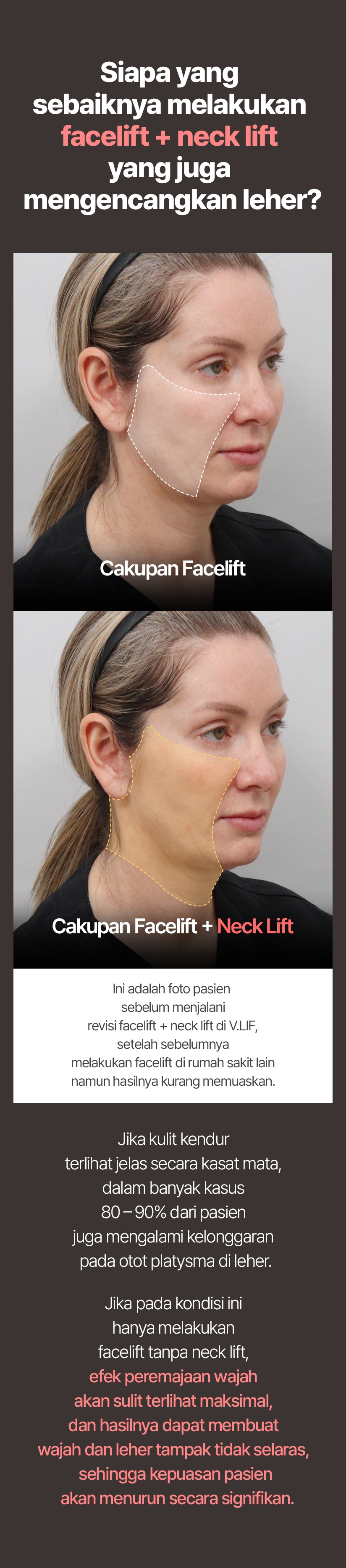 Siapa yang sebaiknya melakukan facelift + neck lift yang juga mengencangkan leher? Cakupan Facelift / Cakupan Facelift + Neck Lift Ini adalah foto pasien sebelum menjalani revisi facelift + neck lift di VLIF, setelah sebelumnya melakukan facelift di rumah sakit lain namun hasilnya kurang memuaskan. Jika kulit kendur terlihat jelas secara kasat mata, dalam banyak kasus 80–90% dari pasien juga mengalami kelonggaran pada otot platysma di leher. Jika pada kondisi ini hanya melakukan facelift tanpa neck lift, efek peremajaan wajah akan sulit terlihat maksimal, dan hasilnya dapat membuat wajah dan leher tampak tidak selaras, sehingga kepuasan pasien akan menurun secara signifikan.