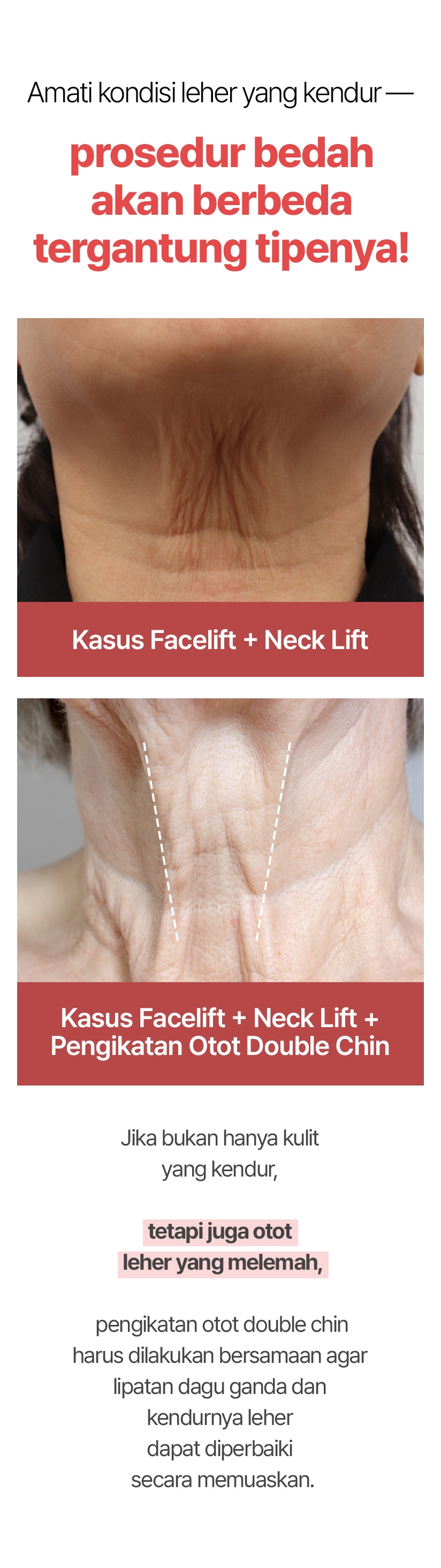 Amati kondisi leher yang kendur — prosedur bedah akan berbeda tergantung tipenya! Kasus Facelift + Neck Lift / Kasus Facelift + Neck Lift + Pengikatan Otot Double Chin Jika bukan hanya kulit yang kendur, tetapi juga otot leher yang melemah, pengikatan otot double chin harus dilakukan bersamaan agar lipatan dagu ganda dan kendurnya leher dapat diperbaiki secara memuaskan.