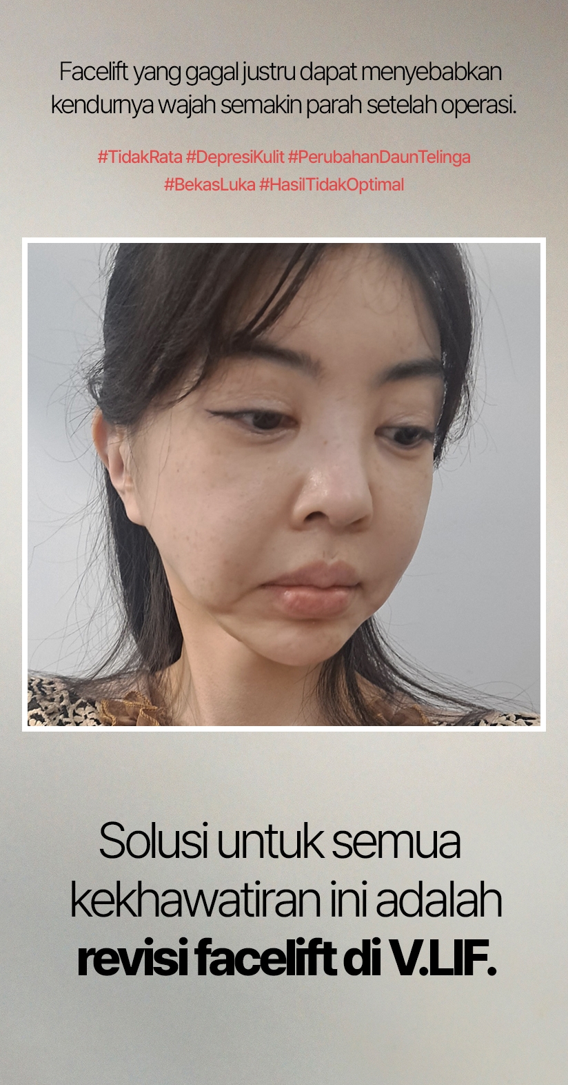 Facelift yang gagal justru dapat menyebabkan kendurnya wajah semakin parah setelah operasi. #TidakRata #DepresiKulit #PerubahanDaunTelinga #BekasLuka #HasilTidakOptimal Solusi untuk semua kekhawatiran ini adalah revisi facelift di V.LIF.