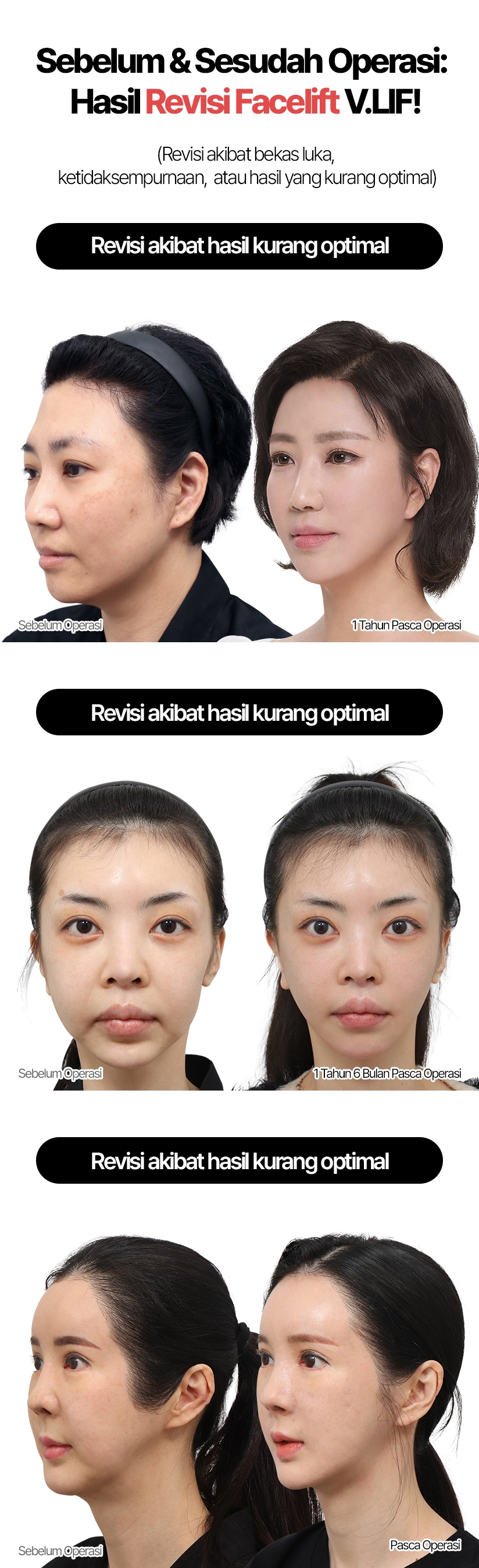Sebelum & Sesudah Operasi: Hasil Revisi Facelift V.LIF! (Revisi akibat bekas luka, ketidaksempurnaan, atau hasil yang kurang optimal) Revisi akibat hasil kurang optimal Sebelum Operasi 1 Tahun Pasca Operasi Revisi akibat hasil kurang optimal Sebelum Operasi 1 Tahun 6 Bulan Pasca Operasi Revisi akibat hasil kurang optimal Sebelum Operasi Pasca Operasi