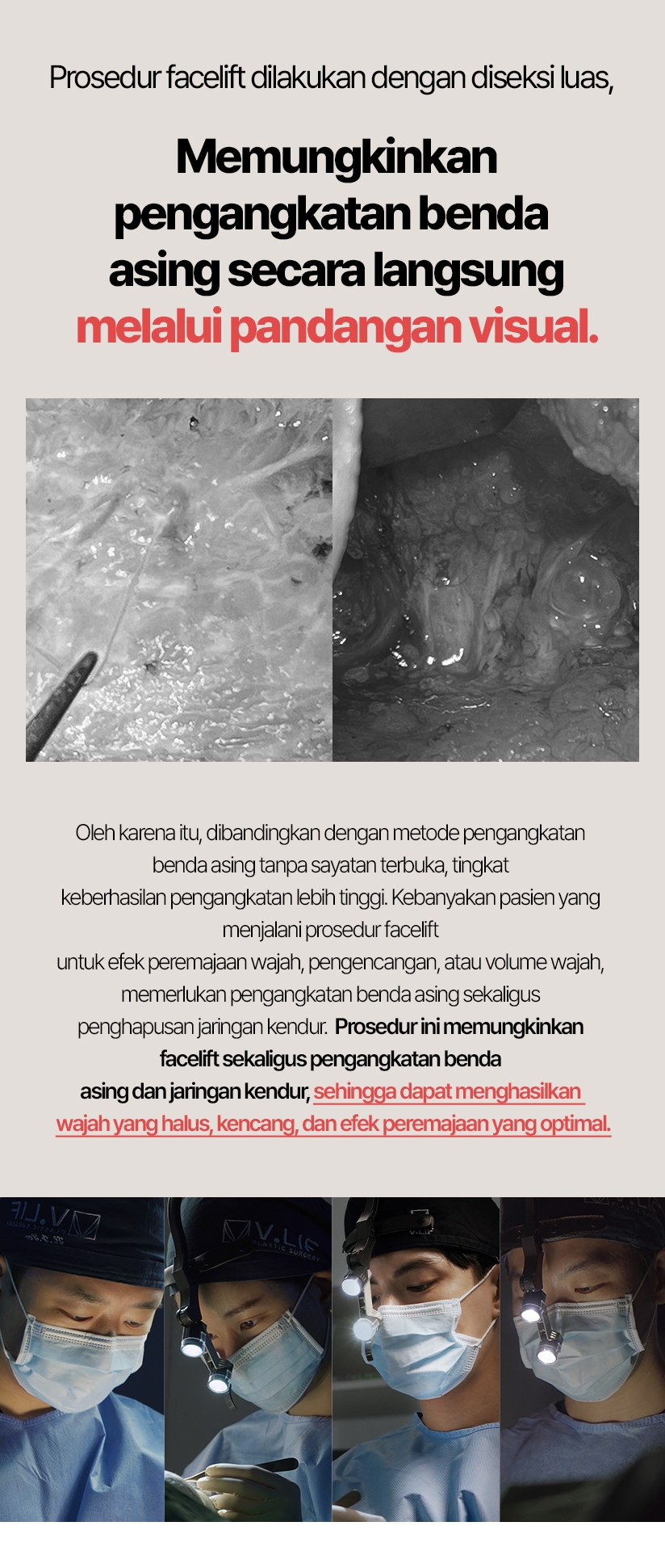 Prosedur facelift dilakukan dengan diseksi luas, memungkinkan pengangkatan benda asing secara langsung melalui pandangan visual. Oleh karena itu, dibandingkan dengan metode pengangkatan benda asing tanpa sayatan terbuka, tingkat keberhasilan pengangkatan lebih tinggi. Kebanyakan pasien yang menjalani prosedur facelift untuk efek peremajaan wajah, pengencangan, atau volume wajah, memerlukan pengangkatan benda asing sekaligus penghapusan jaringan kendur. Prosedur ini memungkinkan facelift sekaligus pengangkatan benda asing dan jaringan kendur, sehingga dapat menghasilkan wajah yang halus, kencang, dan efek peremajaan yang optimal.