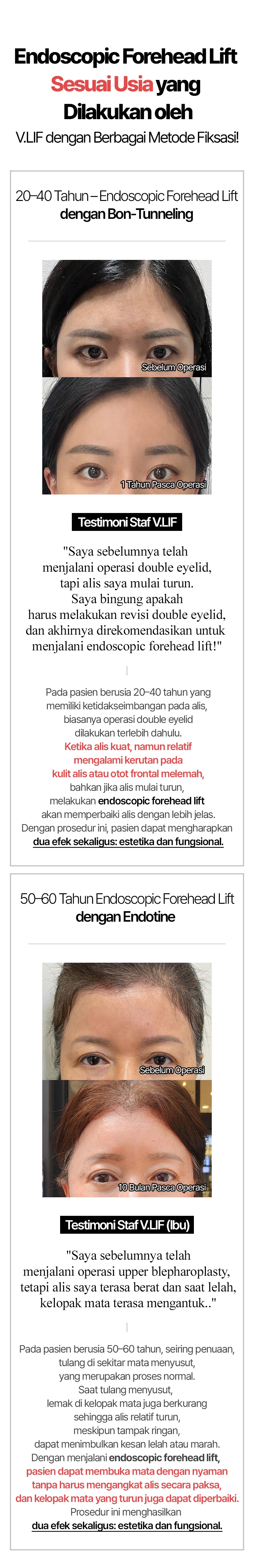 Endoscopic Forehead Lift Sesuai Usia yang Dilakukan oleh V.LIF dengan Berbagai Metode Fiksasi! 20–40 Tahun – Endoscopic Forehead Lift dengan Bon-Tunneling Testimoni Staf V.LIF: Saya sebelumnya telah menjalani operasi double eyelid, tapi alis saya mulai turun. Saya bingung apakah harus melakukan revisi double eyelid, dan akhirnya direkomendasikan untuk menjalani endoscopic forehead lift! Pada pasien berusia 20–40 tahun yang memiliki ketidakseimbangan pada alis, biasanya operasi double eyelid dilakukan terlebih dahulu. Ketika alis kuat, namun relatif mengalami kerutan pada kulit alis atau otot frontal melemah, bahkan jika alis mulai turun, melakukan endoscopic forehead lift akan memperbaiki alis dengan lebih jelas. Dengan prosedur ini, pasien dapat mengharapkan dua efek sekaligus: estetika dan fungsional. 50–60 Tahun Endoscopic Forehead Lift dengan Endotine Testimoni Staf V.LIF (Ibu): Saya sebelumnya telah menjalani operasi upper blepharoplasty, tetapi alis saya terasa berat dan saat lelah, kelopak mata terasa mengantuk.. Pada pasien berusia 50–60 tahun, seiring penuaan, tulang di sekitar mata menyusut, yang merupakan proses normal. Saat tulang menyusut, lemak di kelopak mata juga berkurang sehingga alis relatif turun, meskipun tampak ringan, dapat menimbulkan kesan lelah atau marah. Dengan menjalani endoscopic forehead lift, pasien dapat membuka mata dengan nyaman tanpa harus mengangkat alis secara paksa, dan kelopak mata yang turun juga dapat diperbaiki. Prosedur ini menghasilkan dua efek sekaligus: estetika dan fungsional.