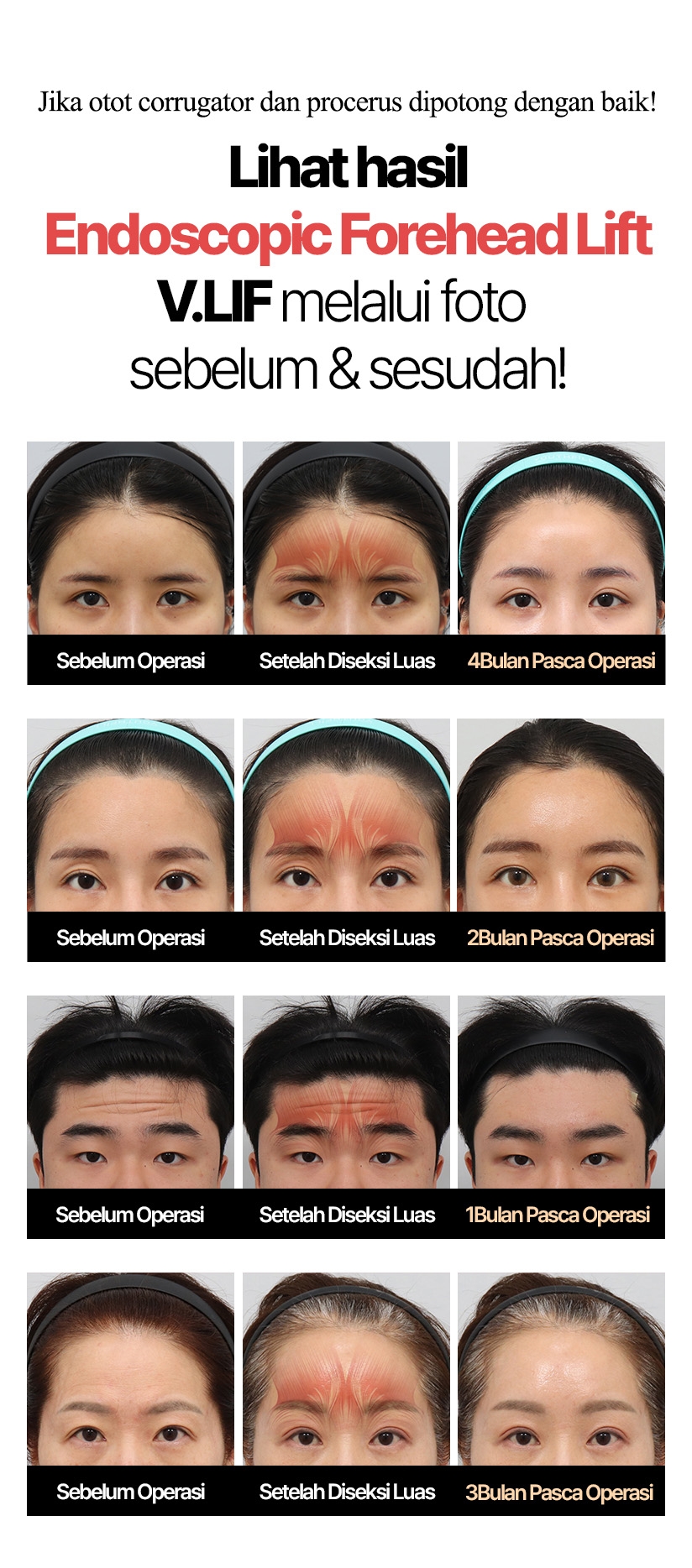 Jika otot corrugator dan procerus dipotong dengan baik! Lihat hasil Endoscopic Forehead Lift V.LIF melalui foto sebelum & sesudah!
