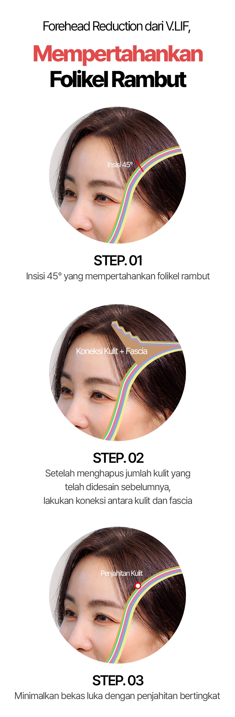 Forehead Reduction dari V.LIF, Mempertahankan Folikel Rambut Insisi 45° Koneksi Kulit + Fascia Koneksi Kulit + Fascia STEP.01 Insisi 45° yang mempertahankan folikel rambut STEP.02 Setelah menghapus jumlah kulit yang telah didesain sebelumnya, lakukan koneksi antara kulit dan fascia STEP.03 Minimalkan bekas luka dengan penjahitan bertingkat
