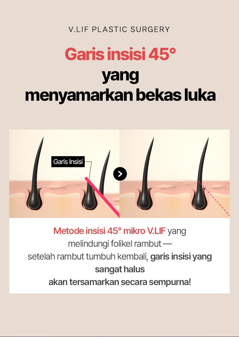 Garis insisi 45° yang menyamarkan bekas luka Metode insisi 45° mikro V.LIF yang melindungi folikel rambut — setelah rambut tumbuh kembali, garis insisi yang sangat halus akan tersamarkan secara sempurna!