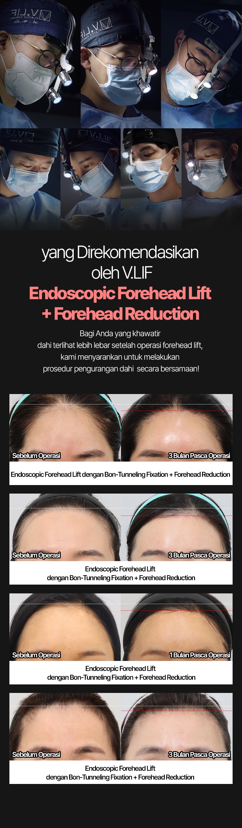 Endoscopic Forehead Lift + Forehead Reduction yang Direkomendasikan oleh V.LIF Bagi Anda yang khawatir dahi terlihat lebih lebar setelah operasi forehead lift, kami menyarankan untuk melakukan prosedur pengurangan dahi secara bersamaan! Sebelum Operasi Endoscopic Forehead Lift dengan Bon-Tunneling Fixation + Forehead Reduction 3 Bulan Pasca Operasi Sebelum Operasi Endoscopic Forehead Lift dengan Bon-Tunneling Fixation + Forehead Reduction 3 Bulan Pasca Operasi Sebelum Operasi Endoscopic Forehead Lift dengan Bon-Tunneling Fixation + Forehead Reduction Bulan Pasca Operasi Sebelum Operasi Endoscopic Forehead Lift dengan Bon-Tunneling Fixation + Forehead Reduction 1 Bulan Pasca Operasi