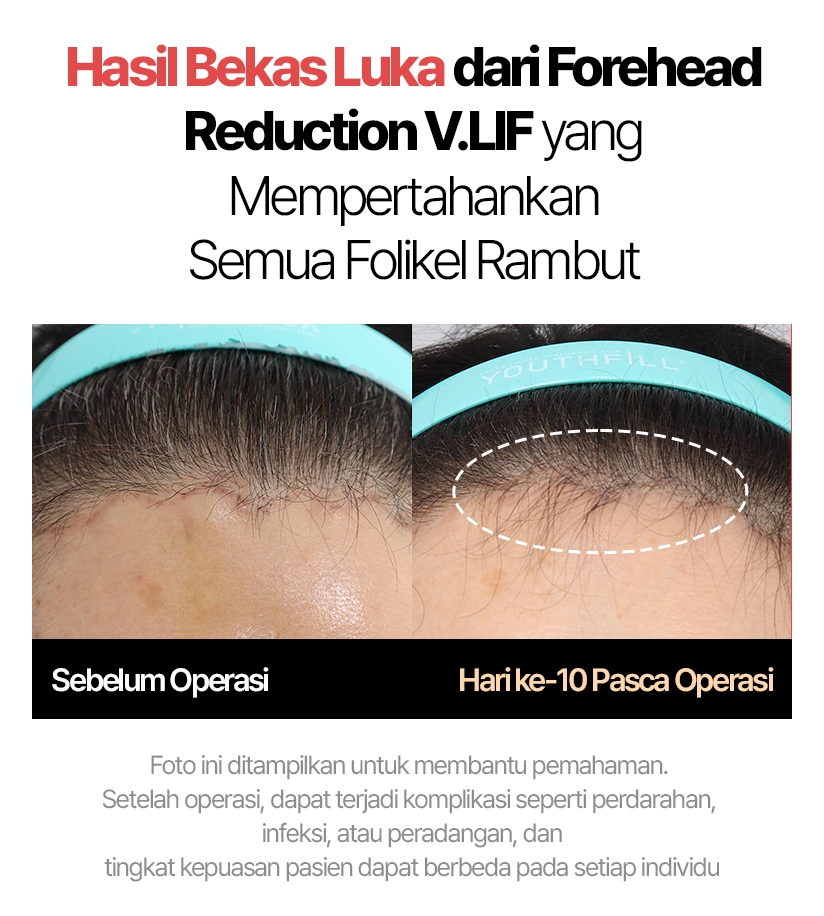 Hasil Bekas Luka dari Forehead Reduction V.LIF yang Mempertahankan Semua Folikel Rambut Sebelum Operasi / Hari ke-10 Pasca Operasi Foto ini ditampilkan untuk membantu pemahaman. Setelah operasi, dapat terjadi komplikasi seperti perdarahan, infeksi, atau peradangan, dan tingkat kepuasan pasien dapat berbeda pada setiap individu