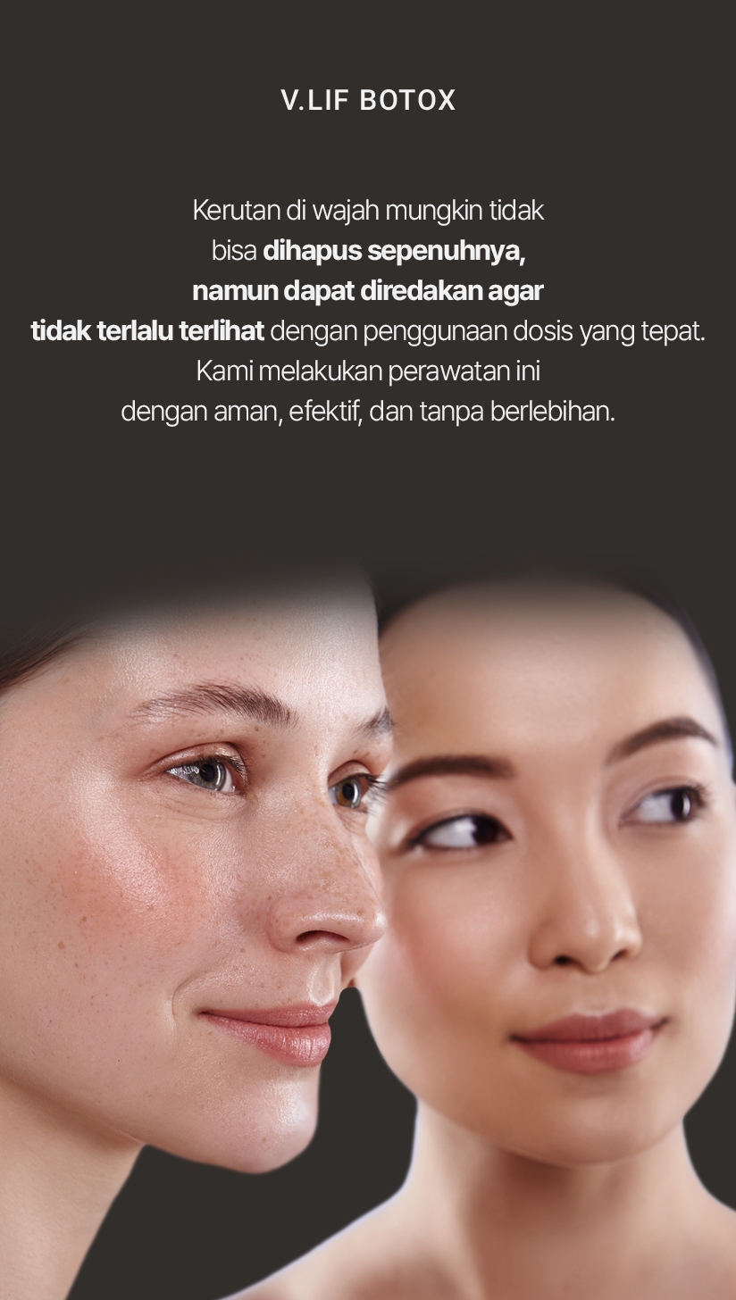 V.LIF BOTOX Kerutan di wajah mungkin tidak bisa dihapus sepenuhnya, namun dapat diredakan agar tidak terlalu terlihat dengan penggunaan dosis yang tepat. Kami melakukan perawatan ini dengan aman, efektif, dan tanpa berlebihan. 