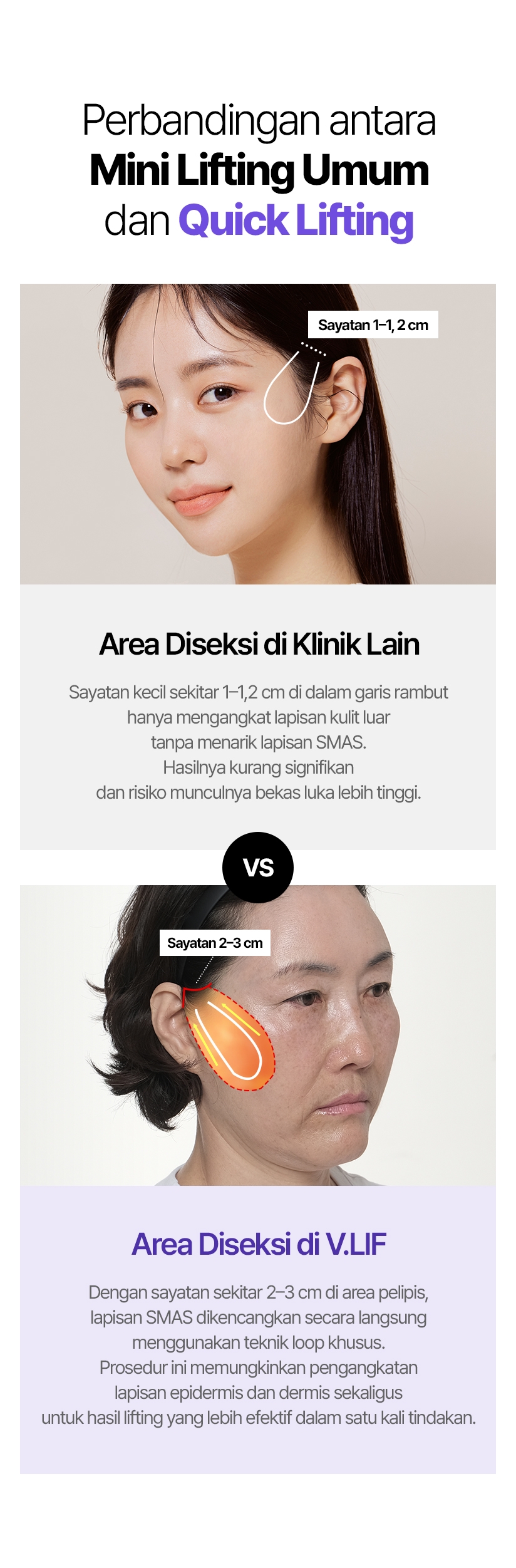 Perbandingan antara Mini Lifting Umum dan Quick Lifting Sayatan 1–1, 2 cm Area Diseksi di Klinik Lain Sayatan kecil sekitar 1–1,2 cm di dalam garis rambut hanya mengangkat lapisan kulit luar tanpa menarik lapisan SMAS. Hasilnya kurang signifikan dan risiko munculnya bekas luka lebih tinggi. Sayatan 2–3 cm Area Diseksi di V.LIF Dengan sayatan sekitar 2–3 cm di area pelipis, lapisan SMAS dikencangkan secara langsung menggunakan teknik loop khusus. Prosedur ini memungkinkan pengangkatan lapisan epidermis dan dermis sekaligus untuk hasil lifting yang lebih efektif dalam satu kali tindakan.