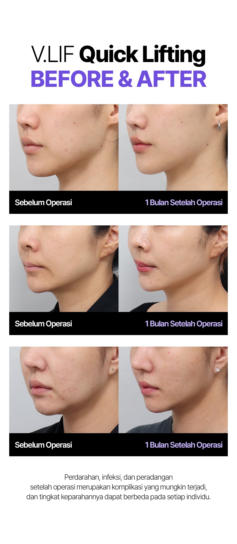 Sebelum Operasi 1 Bulan Setelah Operasi Perdarahan, infeksi, dan peradangan setelah operasi merupakan komplikasi yang mungkin terjadi, dan tingkat keparahannya dapat berbeda pada setiap individu.