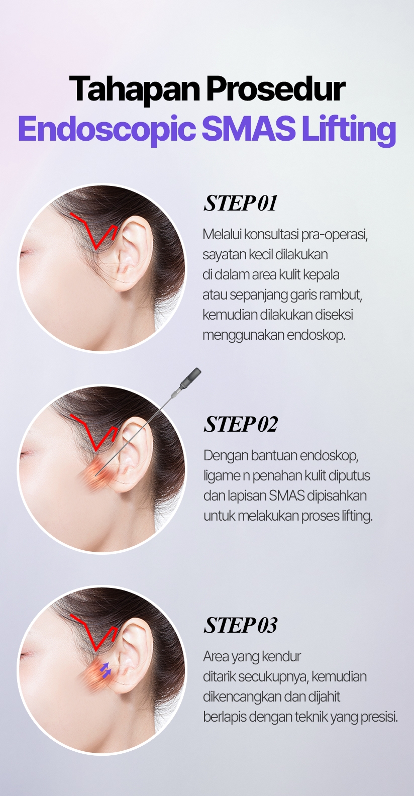 Tahapan Prosedur Endoscopic SMAS Lifting STEP 01 Melalui konsultasi pra-operasi, sayatan kecil dilakukan di dalam area kulit kepala atau sepanjang garis rambut, kemudian dilakukan diseksi menggunakan endoskop. STEP 02 Dengan bantuan endoskop, ligame n penahan kulit diputus dan lapisan SMAS dipisahkan untuk melakukan proses lifting. STEP 03 Area yang kendur ditarik secukupnya, kemudian dikencangkan dan dijahit berlapis dengan teknik yang presisi.