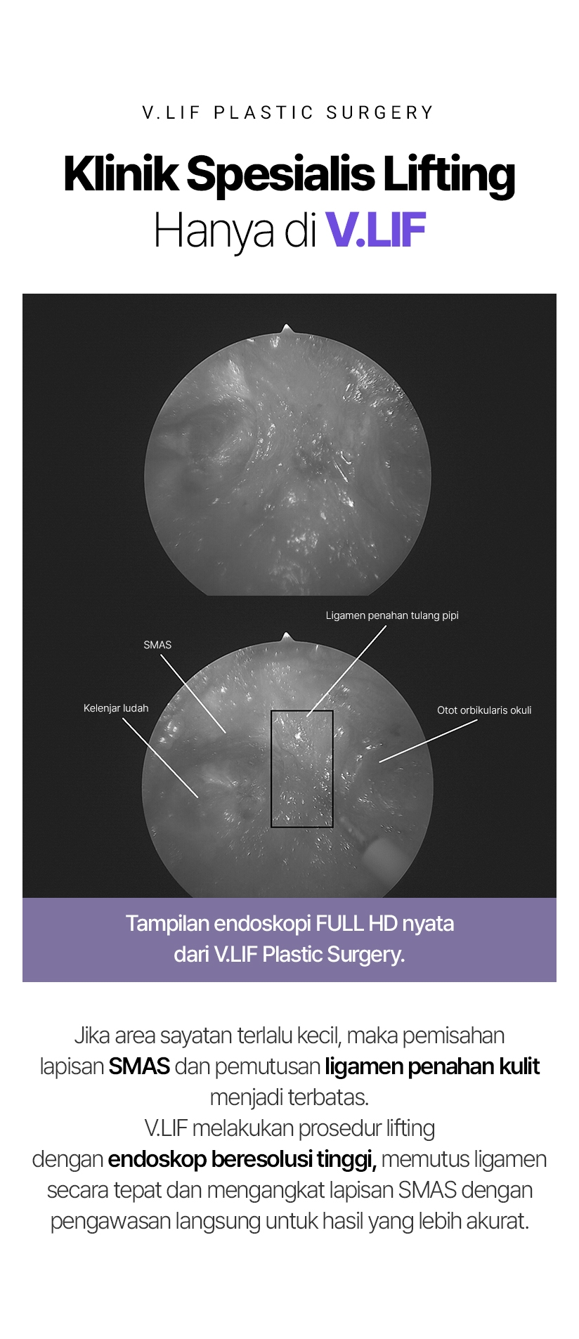 V.LIF PLASTIC SURGERY Klinik Spesialis Lifting Hanya di V.LIF SMAS Kelenjar ludah Ligamen penahan tulang pipi Otot orbikularis okuli Tampilan endoskopi FULL HD nyata dari V.LIF Plastic Surgery. Jika area sayatan terlalu kecil, maka pemisahan lapisan SMAS dan pemutusan ligamen penahan kulit menjadi terbatas. V.LIF melakukan prosedur lifting dengan endoskop beresolusi tinggi, memutus ligamen secara tepat dan mengangkat lapisan SMAS dengan pengawasan langsung untuk hasil yang lebih akurat.
