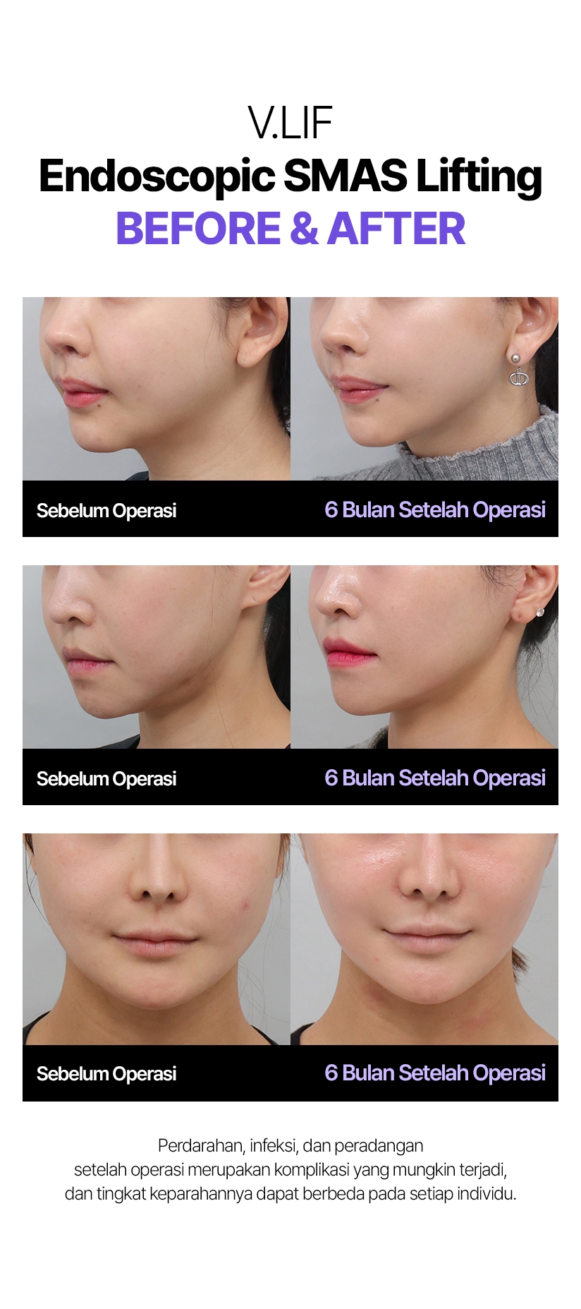 V.LIF Endoscopic SMAS Lifting Before & After Sebelum Operasi 6 Bulan Setelah Operasi Perdarahan, infeksi, dan peradangan setelah operasi merupakan komplikasi yang mungkin terjadi, dan tingkat keparahannya dapat berbeda pada setiap individu.
