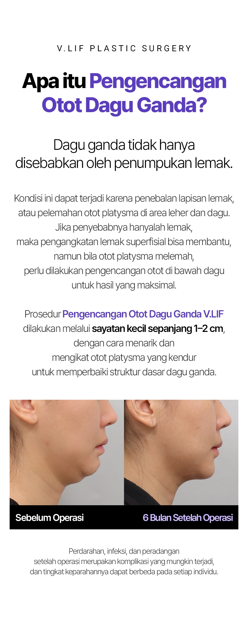 V.LIF PLASTIC SURGERY Apa itu Pengencangan Otot Dagu Ganda? Dagu ganda tidak hanya disebabkan oleh penumpukan lemak. Kondisi ini dapat terjadi karena penebalan lapisan lemak, atau pelemahan otot platysma di area leher dan dagu. Jika penyebabnya hanyalah lemak, maka pengangkatan lemak superfisial bisa membantu, namun bila otot platysma melemah, perlu dilakukan pengencangan otot di bawah dagu untuk hasil yang maksimal. Prosedur Pengencangan Otot Dagu Ganda V.LIF dilakukan melalui sayatan kecil sepanjang 1–2 cm, dengan cara menarik dan mengikat otot platysma yang kendur untuk memperbaiki struktur dasar dagu ganda. Sebelum Operasi 6 Bulan Setelah Operasi Perdarahan, infeksi, dan peradangan setelah operasi merupakan komplikasi yang mungkin terjadi, dan tingkat keparahannya dapat berbeda pada setiap individu.