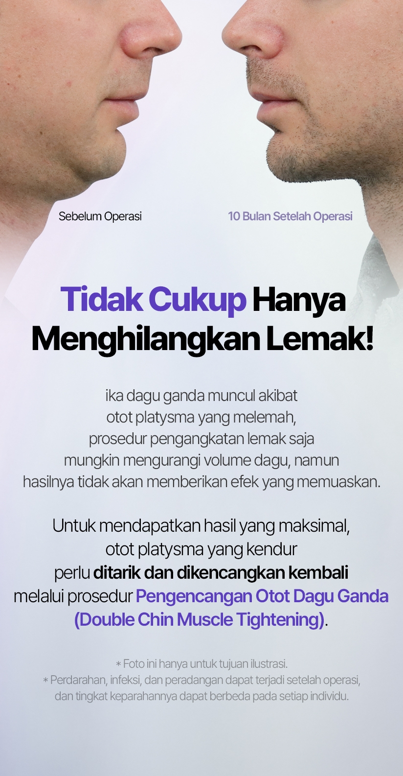Tidak Cukup Hanya Menghilangkan Lemak! ika dagu ganda muncul akibat otot platysma yang melemah, prosedur pengangkatan lemak saja mungkin mengurangi volume dagu, namun hasilnya tidak akan memberikan efek yang memuaskan. Untuk mendapatkan hasil yang maksimal, otot platysma yang kendur perlu ditarik dan dikencangkan kembali melalui prosedur Pengencangan Otot Dagu Ganda (Double Chin Muscle Tightening). * Foto ini hanya untuk tujuan ilustrasi. * Perdarahan, infeksi, dan peradangan dapat terjadi setelah operasi, dan tingkat keparahannya dapat berbeda pada setiap individu. Sebelum Operasi  10 Bulan Setelah Operasi