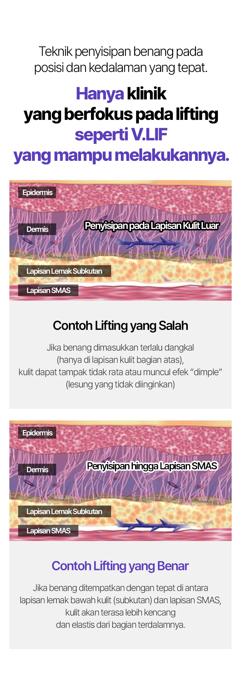 Teknik penyisipan benang pada posisi dan kedalaman yang tepat. Hanya klinik yang berfokus pada lifting seperti V.LIF yang mampu melakukannya. Epidermis Dermis(Penyisipan pada Lapisan Kulit Luar) Lapisan Lemak Subkutan Lapisan SMAS Contoh Lifting yang Salah Jika benang dimasukkan terlalu dangkal (hanya di lapisan kulit bagian atas), kulit dapat tampak tidak rata atau muncul efek “dimple” (lesung yang tidak diinginkan) Epidermis Dermis(Penyisipan hingga Lapisan SMAS ) Lapisan Lemak Subkutan Lapisan SMAS Contoh Lifting yang Benar Jika benang ditempatkan dengan tepat di antara lapisan lemak bawah kulit (subkutan) dan lapisan SMAS, kulit akan terasa lebih kencang dan elastis dari bagian terdalamnya.
