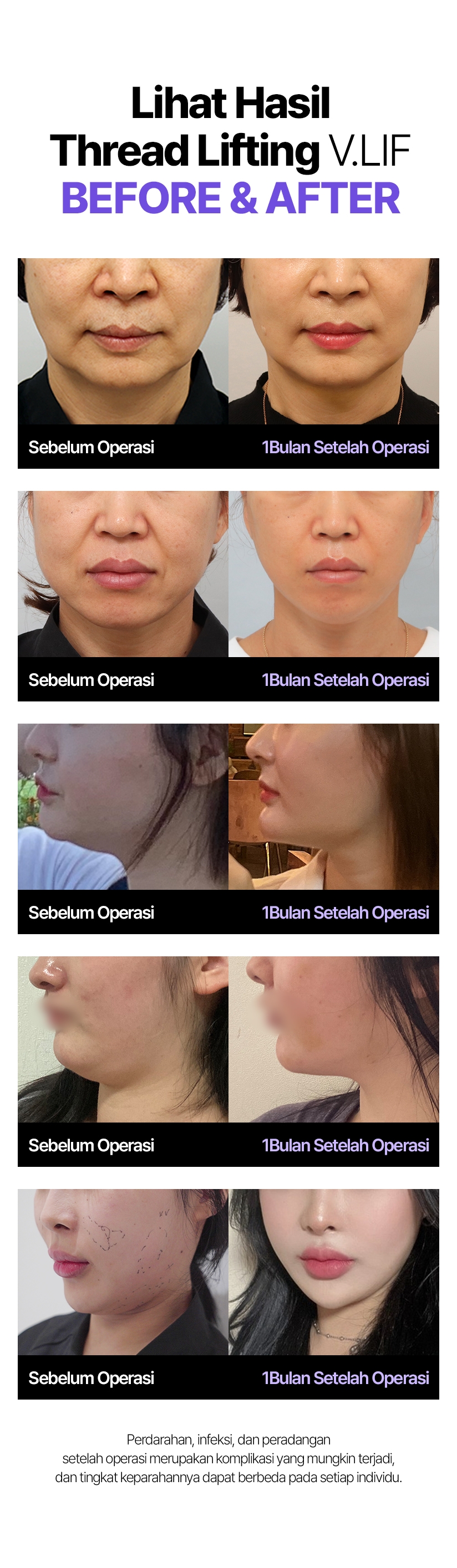 Lihat Hasil Thread Lifting V.LIF Before & After Sebelum Operasi 1Bulan Setelah Operasi Perdarahan, infeksi, dan peradangan setelah operasi merupakan komplikasi yang mungkin terjadi, dan tingkat keparahannya dapat berbeda pada setiap individu.